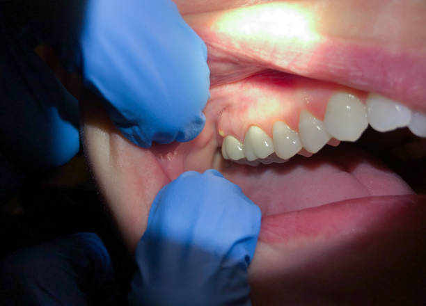 Best Knocked-Out Tooth (Avulsed Tooth) Treatment in Jurupa Valley, CA